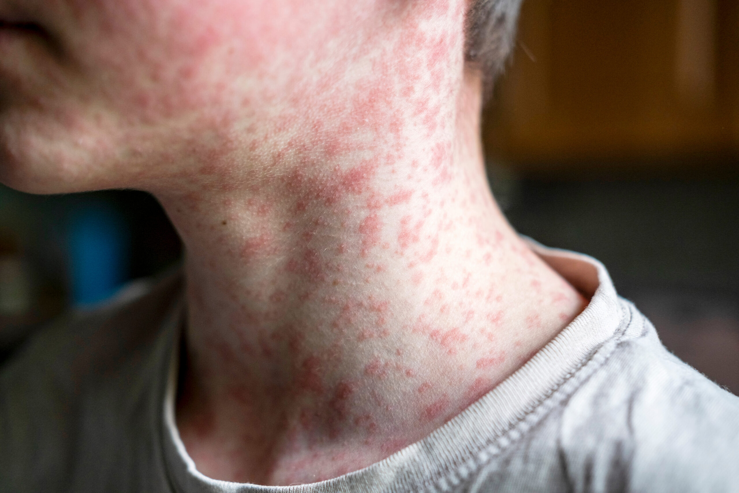 wp content2Fuploads2Fsites2F22F20252F032Fmeasles viral disease human skin 99627545 9w79jM scaled